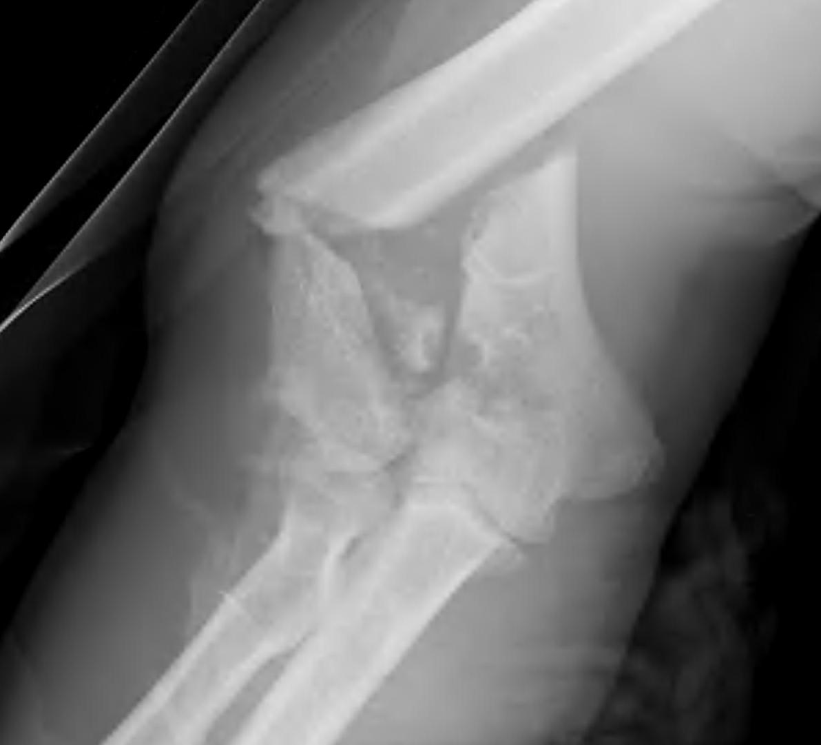 Distal Humeral Fracture